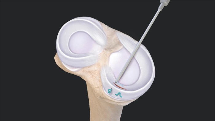 Smith nephew meniscal root repair