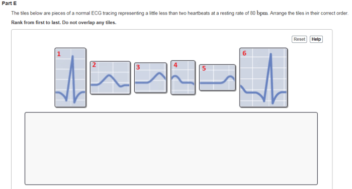 Ecg wave qrs interpretation sinus segment ekg waves intervals