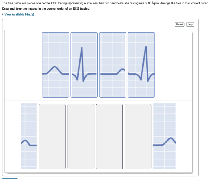 The tiles below are pieces of a normal ecg